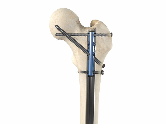 OrthoXel Apex Femoral Nail - ORTHOFLASH