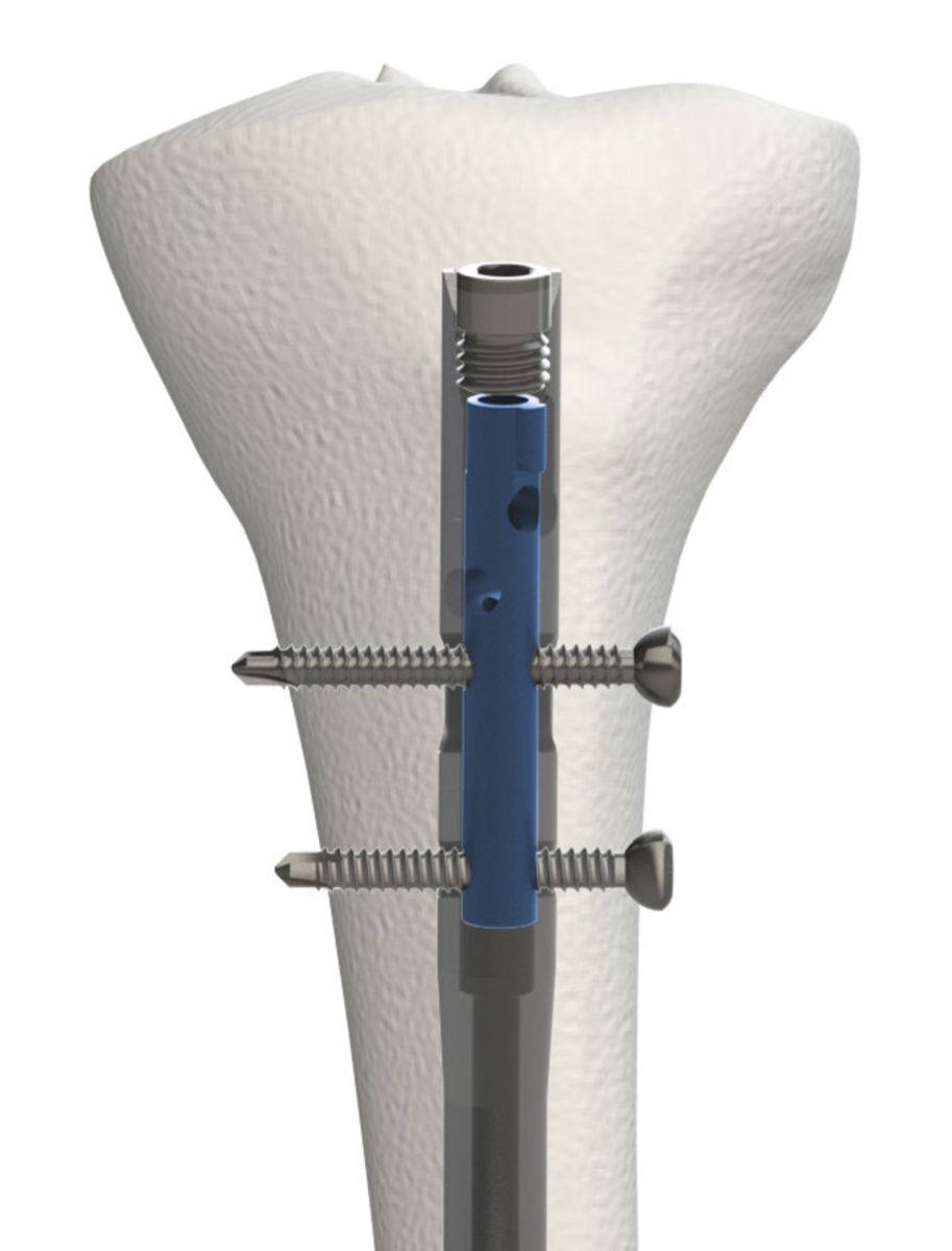 OrthoXel Apex Tibial Nailing System