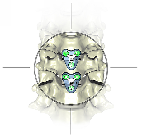 Atlas Spine V3 Guided Segmental Plating - ORTHOWORLD