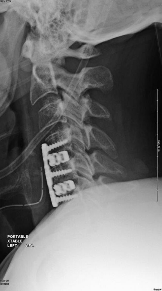 Camber Spine Technologies Spira-C Open Matrix Cervical Interbody on X-ray