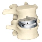 Centinel Spine prodisc L Total Disc Replacement