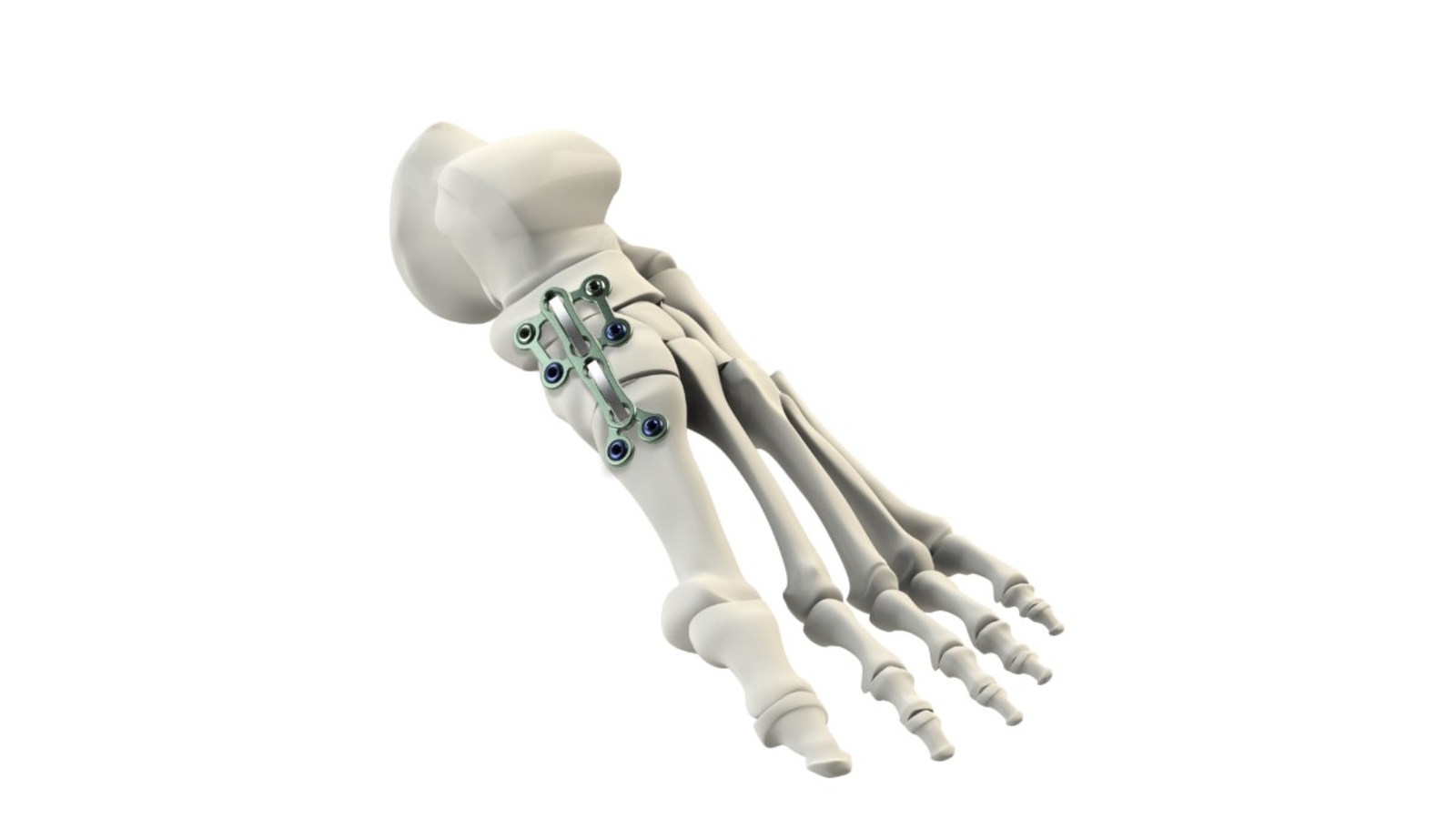 CrossRoads Extremity Systems Vero Medial Column Implant