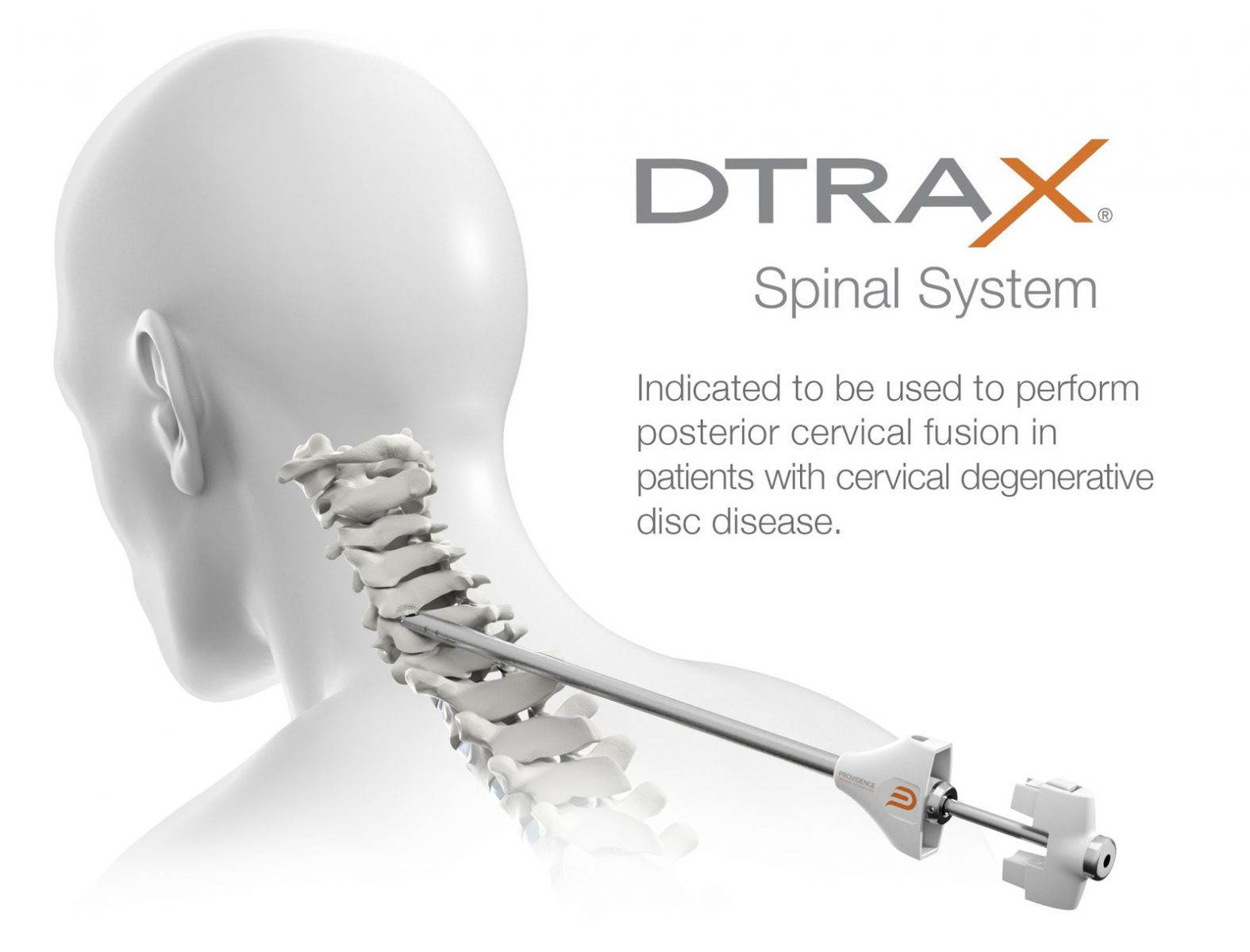 Providence Medical Technology DTRAX Spinal System