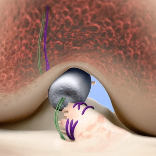 MIACH Orthopaedics BEAR Procedure - ORTHOKNOW