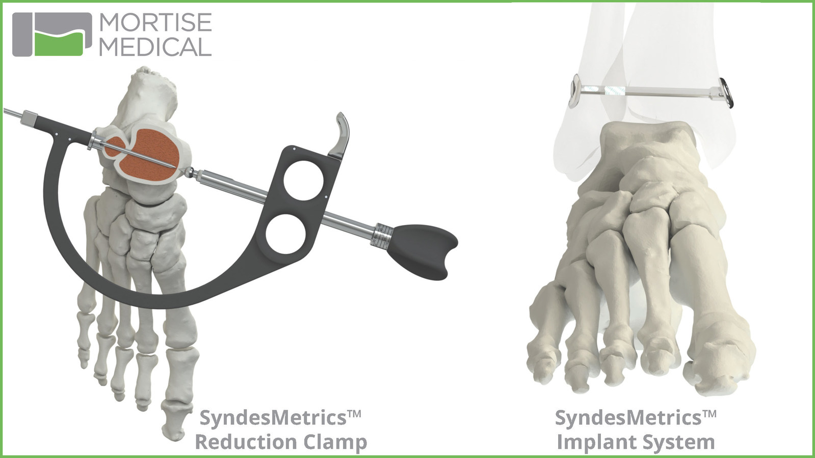 Mortise Medical SyndesMetrics for Syndesmosis Repair