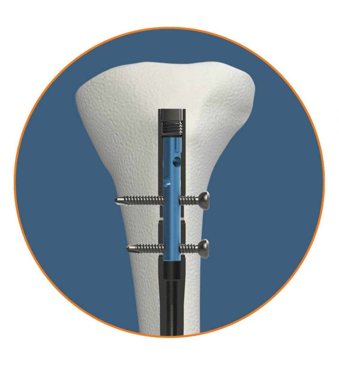 OrthoXel Apex Tibial Nailing System