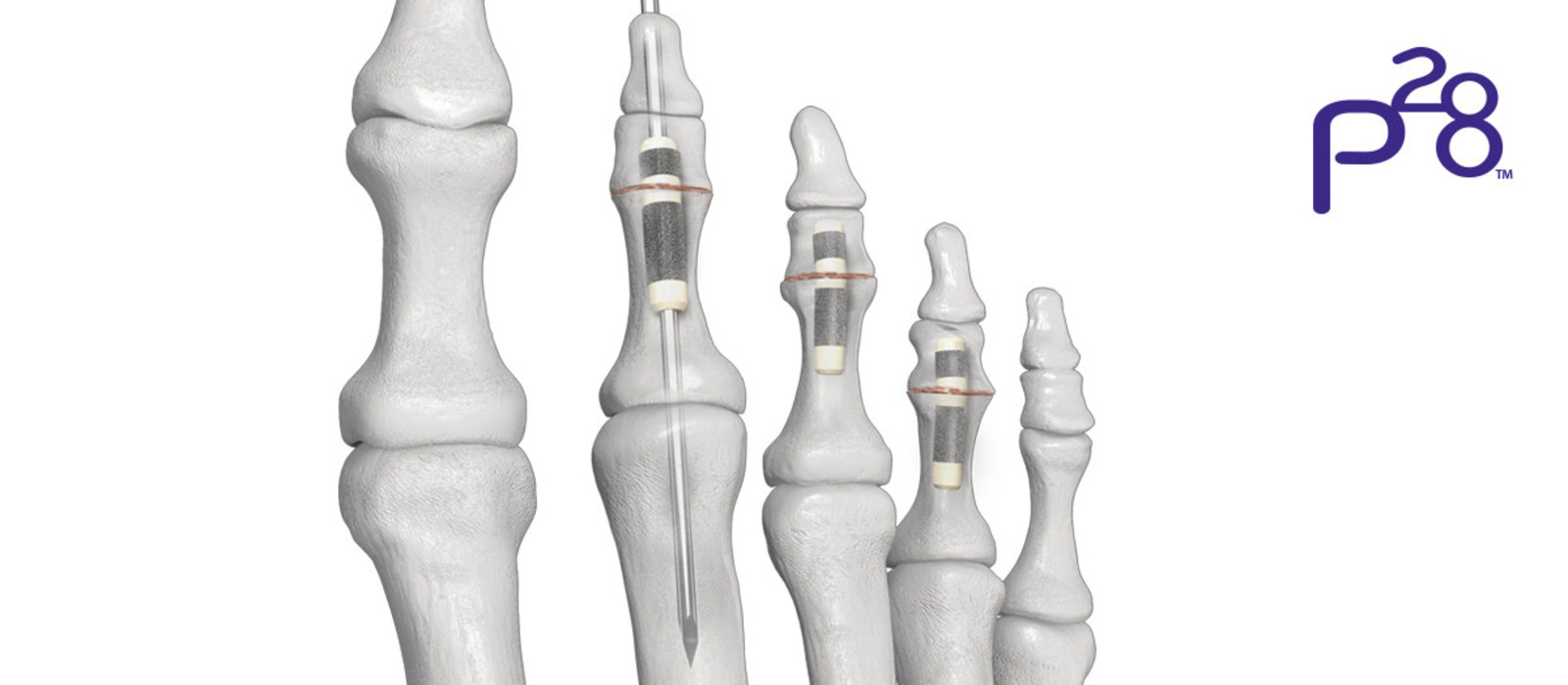 Pargon 28 HammerTube Implant System