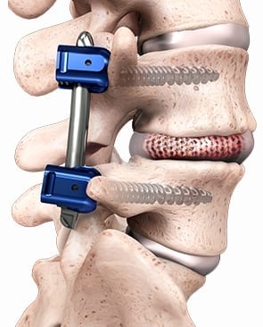 Spineology SCOUT Trial of OptiMesh