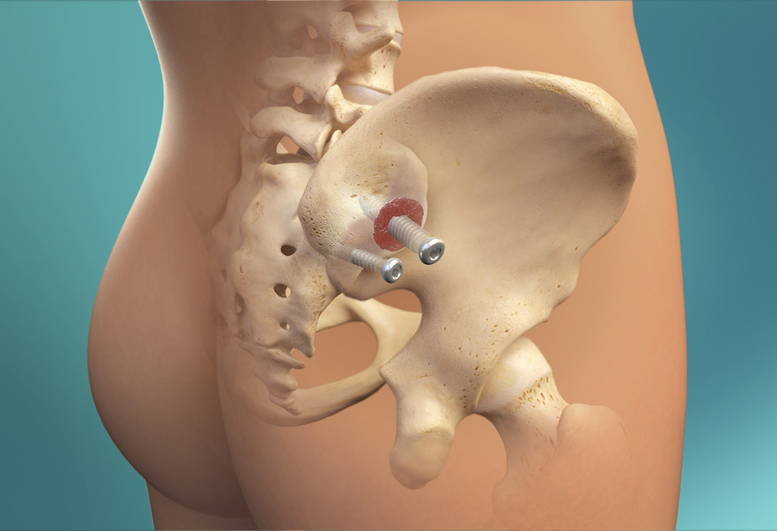 Zyga SImmetry Sacroiliac Joint Fusion System