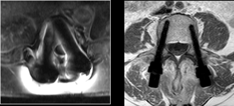 CarboClear Fenestrated Pedicle Screw - ORTHOWORLD