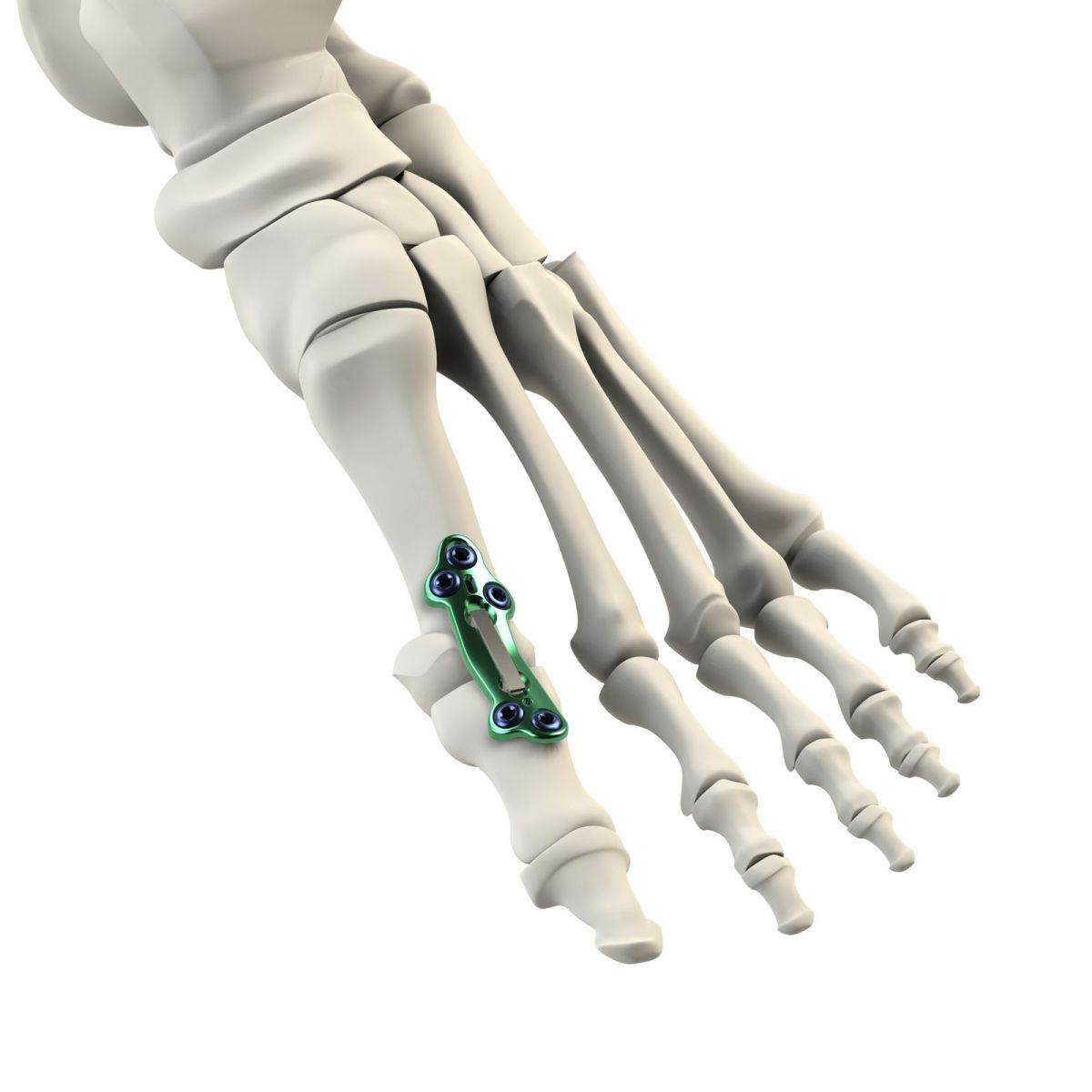 CrossRoads Extremity Systems DynaFORCE MPJ Implant