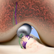 MIACH Orthopaedics BEAR Procedure - ORTHOFLASH