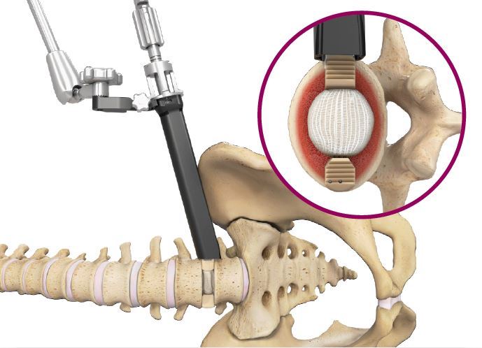 Spineology Duo Angled Instrumentation - ORTHOFLASH