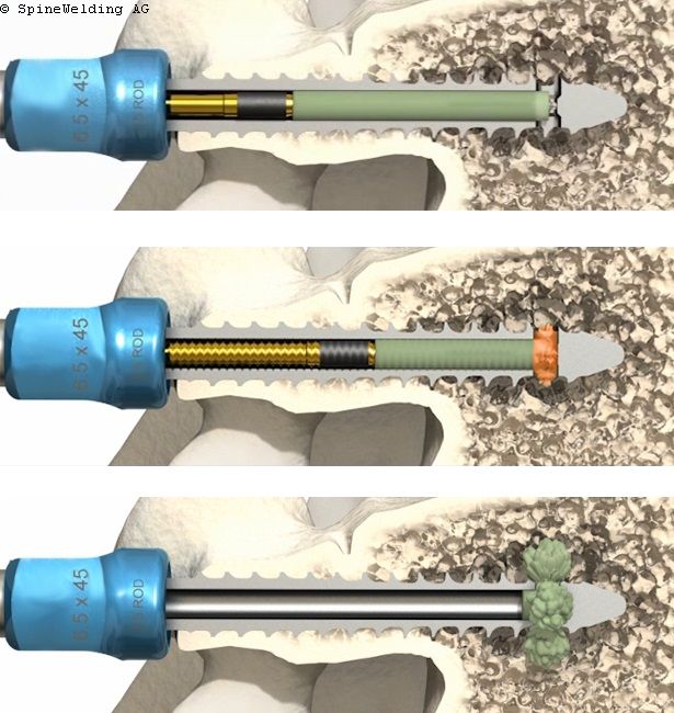 SpineWelding Elaris Pedicle Screw - ORTHOWORLD