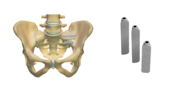 SI-BONE iFuse Implant