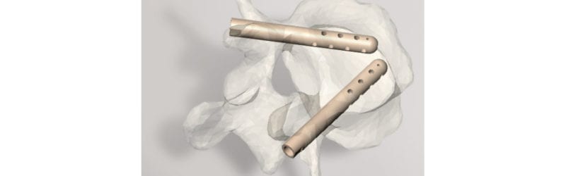 Hyprevention V-STRUT