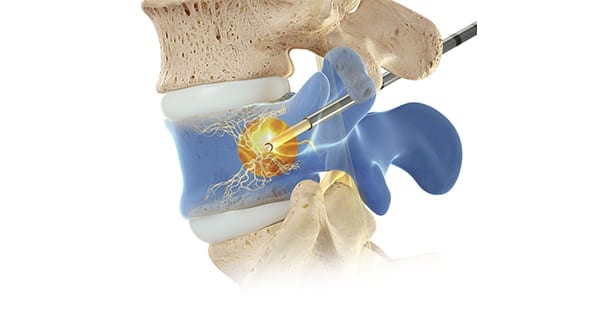 Relievant Intracept