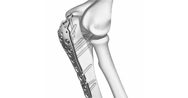 Siora Surgicals Locking Plates