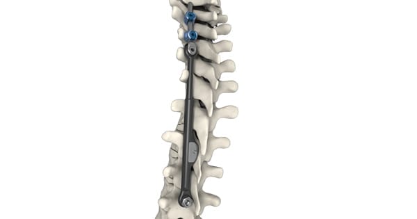 ApiFix Scoliosis System