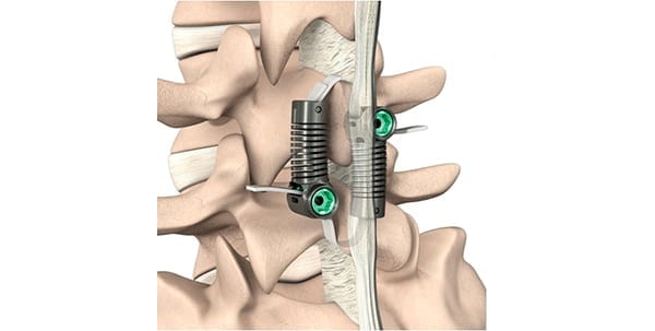 Empirical Spine LimiFlex