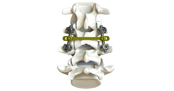 KAHTNU Surgical Talkeetna Pedicle Screw