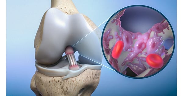 Biorez BioBrace Implant