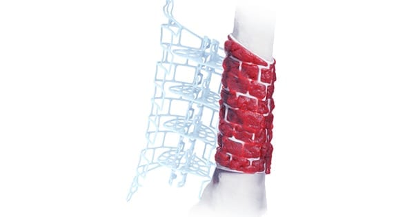 DePuy Synthes TRUMATCH Graft Cage