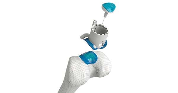 Episurf Medical Episealer Knee