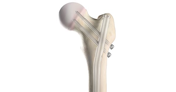 OrthoPediatrics PNP Femur