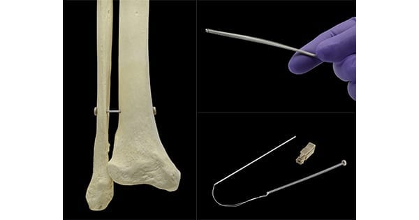 Panther Orthopedics PUMA System