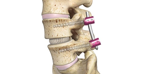 Spineology OptiLIF