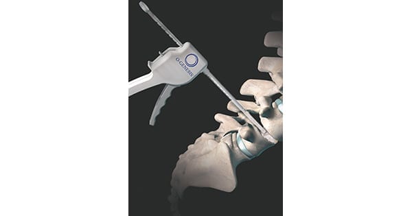 Orthofix O-GENESIS Graft Delivery