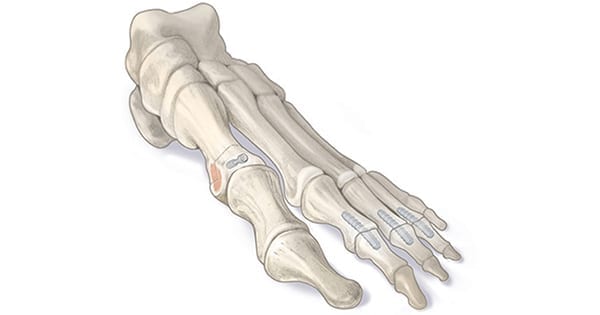 Ossio OSSIOfiber Hammertoe Fixation