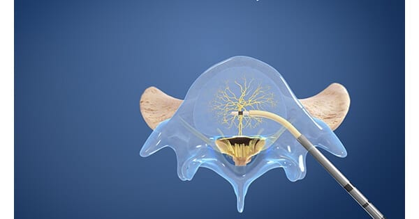 Relievant Medsystems Intracept Procedure