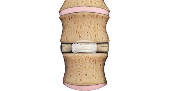 Spineology Duo Interbody Fusion