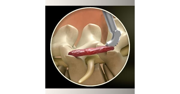 SurGenTec 3D Graft Rasp