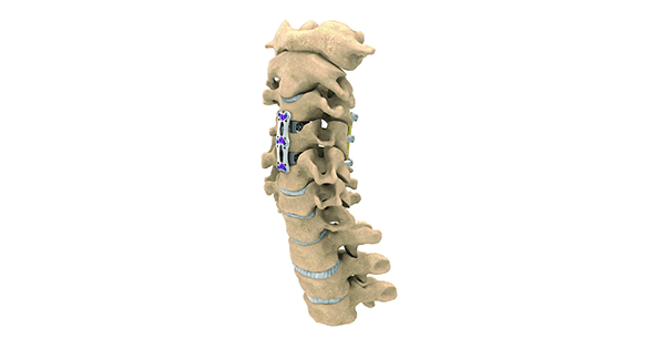 NuVasive Anterior Cervical Plate