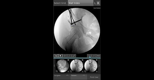 OrthoGrid PhantomMSK Hip Preservation