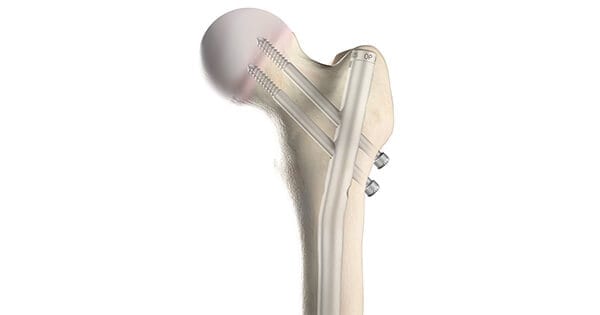 OrthoPediatrics PNP | FEMUR