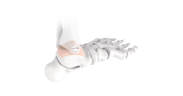 Episurf Medical Talus Ankle Implant