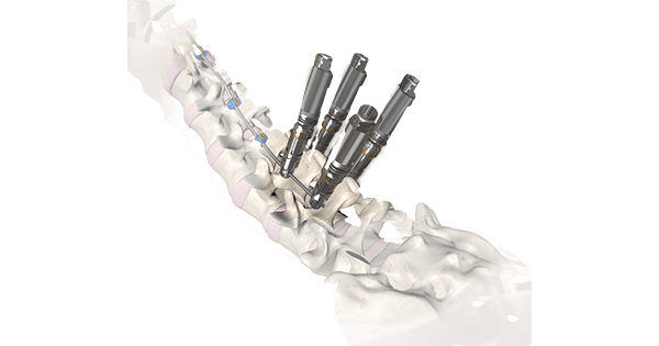 OrthoPediatrics RESPONSE Scoliosis System