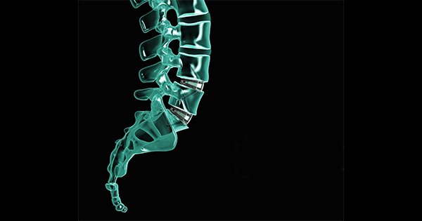 Axis Spine Technology