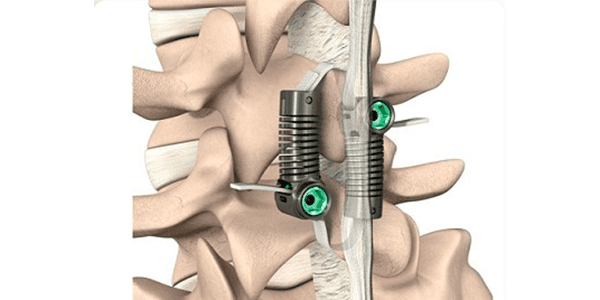 Empirical Spine Limiflex Band