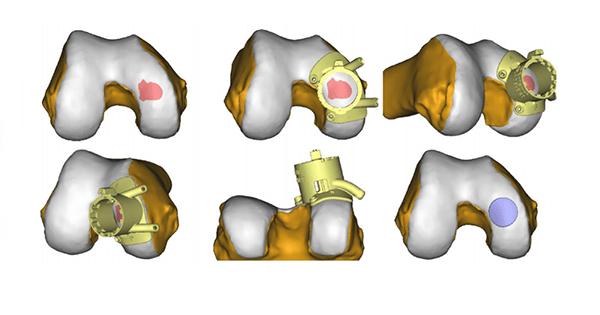 Episurf Medical 3D Visualization