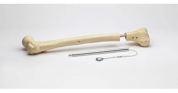 Orthofix Medical FITBONE Limb Lengthening