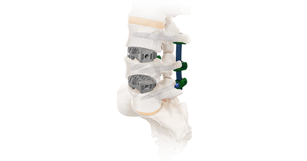 Camber Spine SPIRA-O Open Matrix
