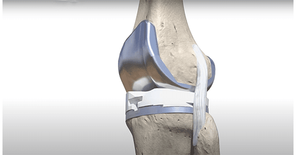 MicroPort Orthopedics Evolution Medial-Pivot Knee