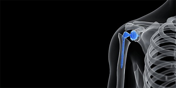 Orthopedic Market 2022 Projections & 2023 Outlook