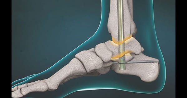 MedShape DynaNil TTC Fusion