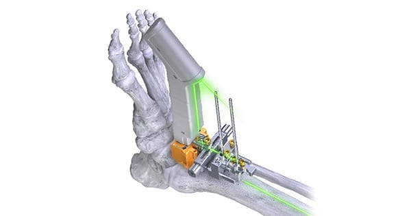 Paragon 28 FasTrac Distal Tibia Alignment